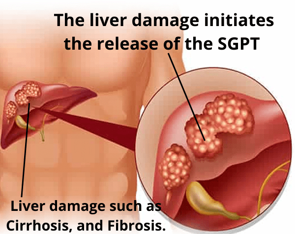 Liver Damage Such As Cirrhosis And Fibrosis. 1
